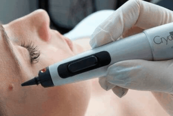 CryoPen behandeling bij Skin & Care voor het veilig verwijderen van huidoneffenheden zoals steelwratjes, fibromen en ouderdomsvlekken