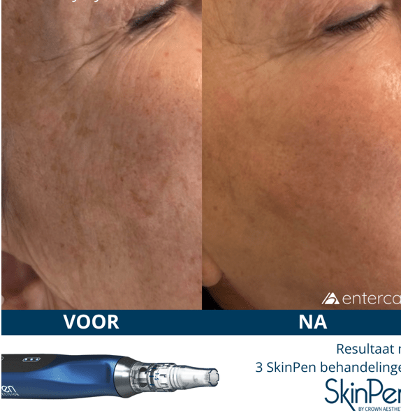 SkinPen voor en na behandeling bij Skin & Care