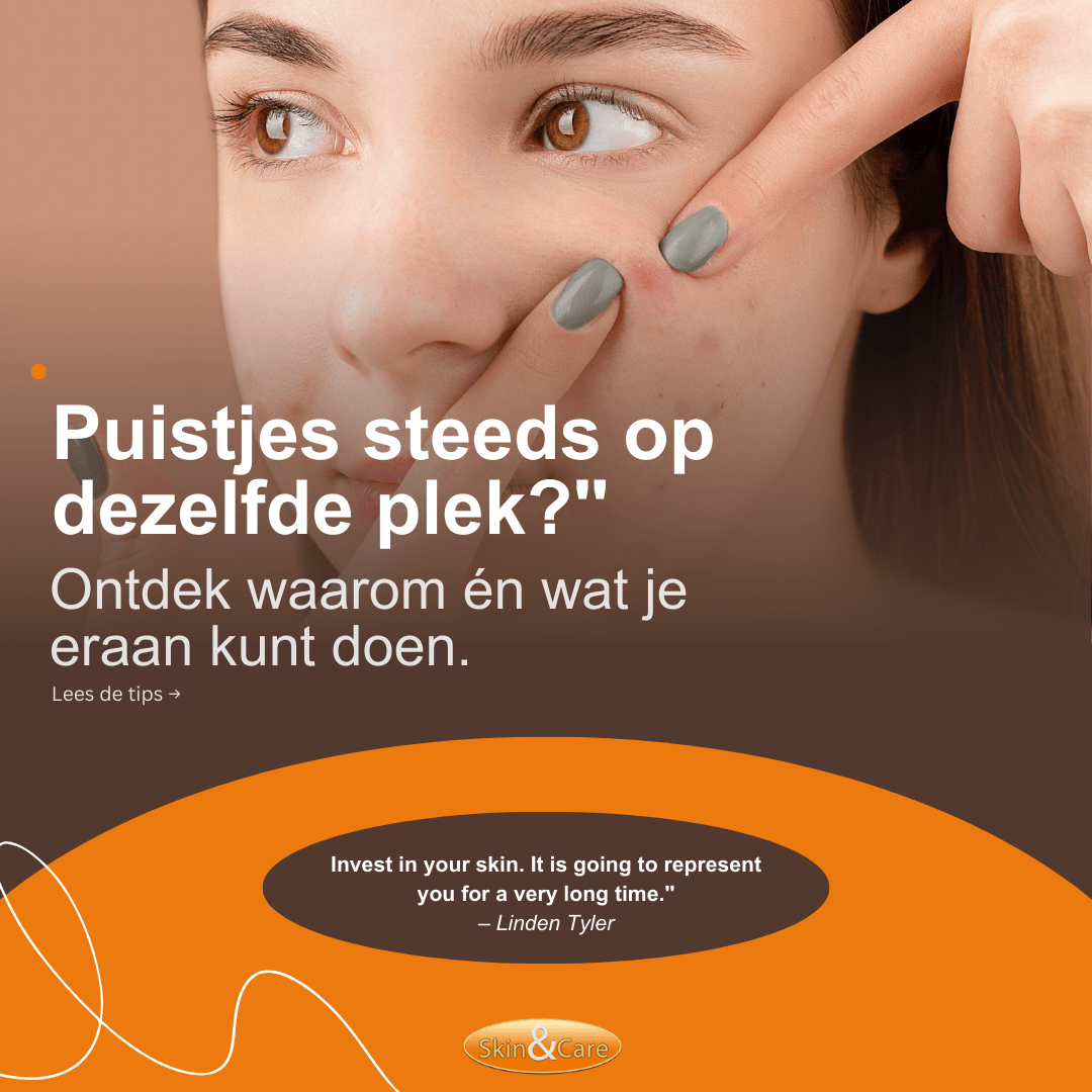 Altijd een puist op dezelfde plek? Dit is waarom – en wat je eraan kunt doen, Skin & Care