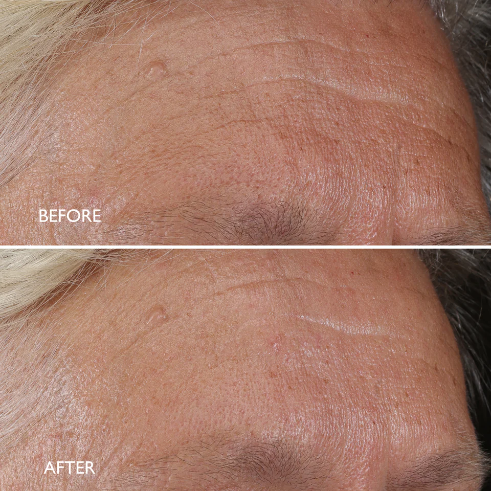 Gatineau Age Benefit Night Renewal Cream_SkinCare_Voor_na